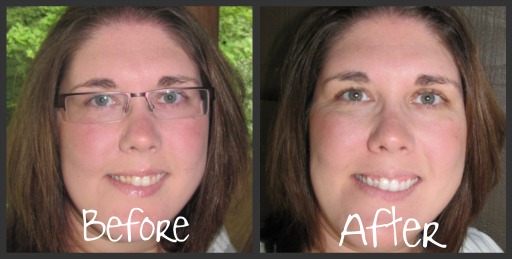 Crest 3D White 2 Hour Express Whitestrips Before and After