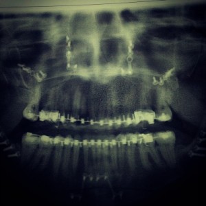 Day 2 X-Ray